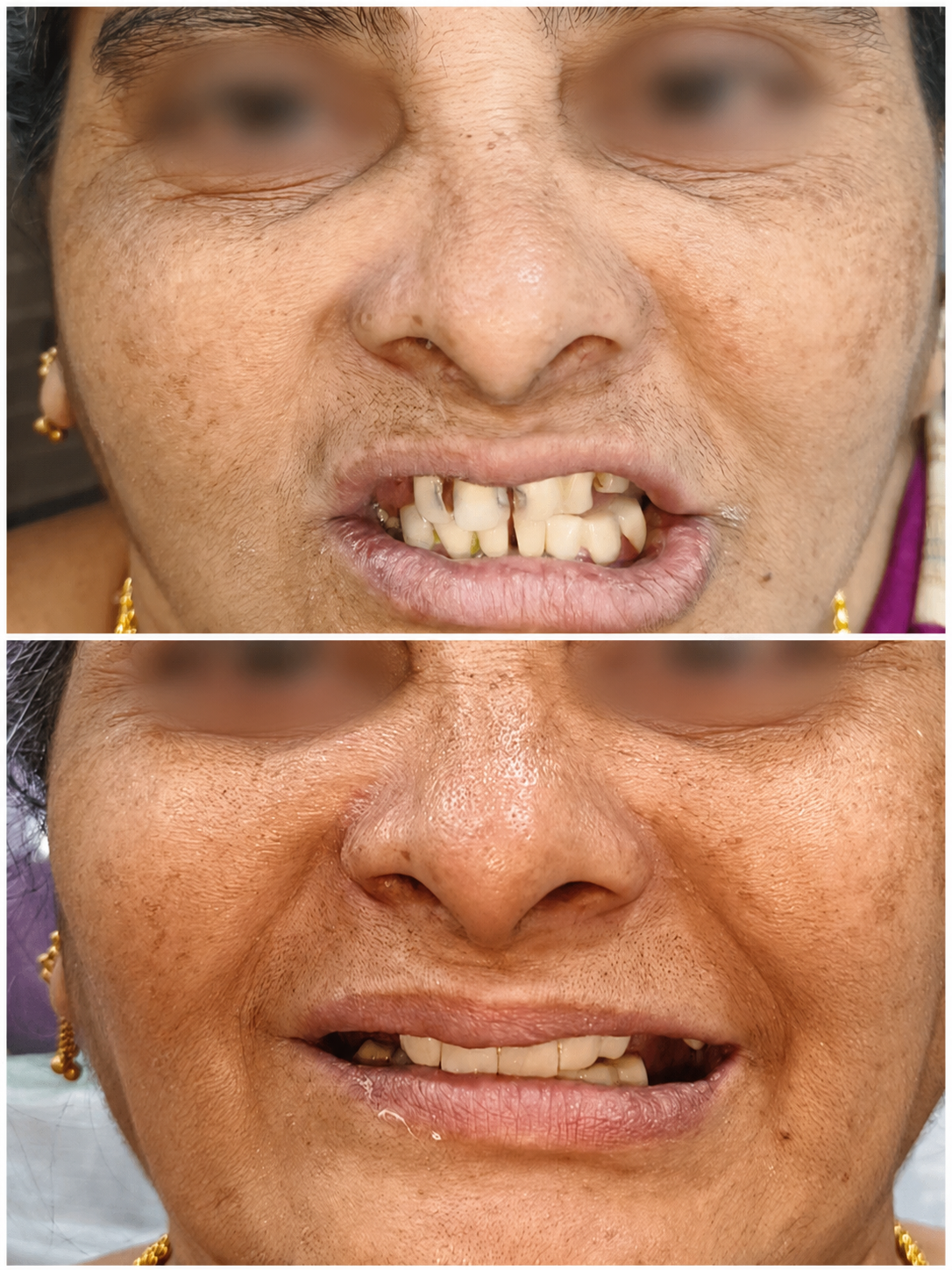 Smile transformation Madurai