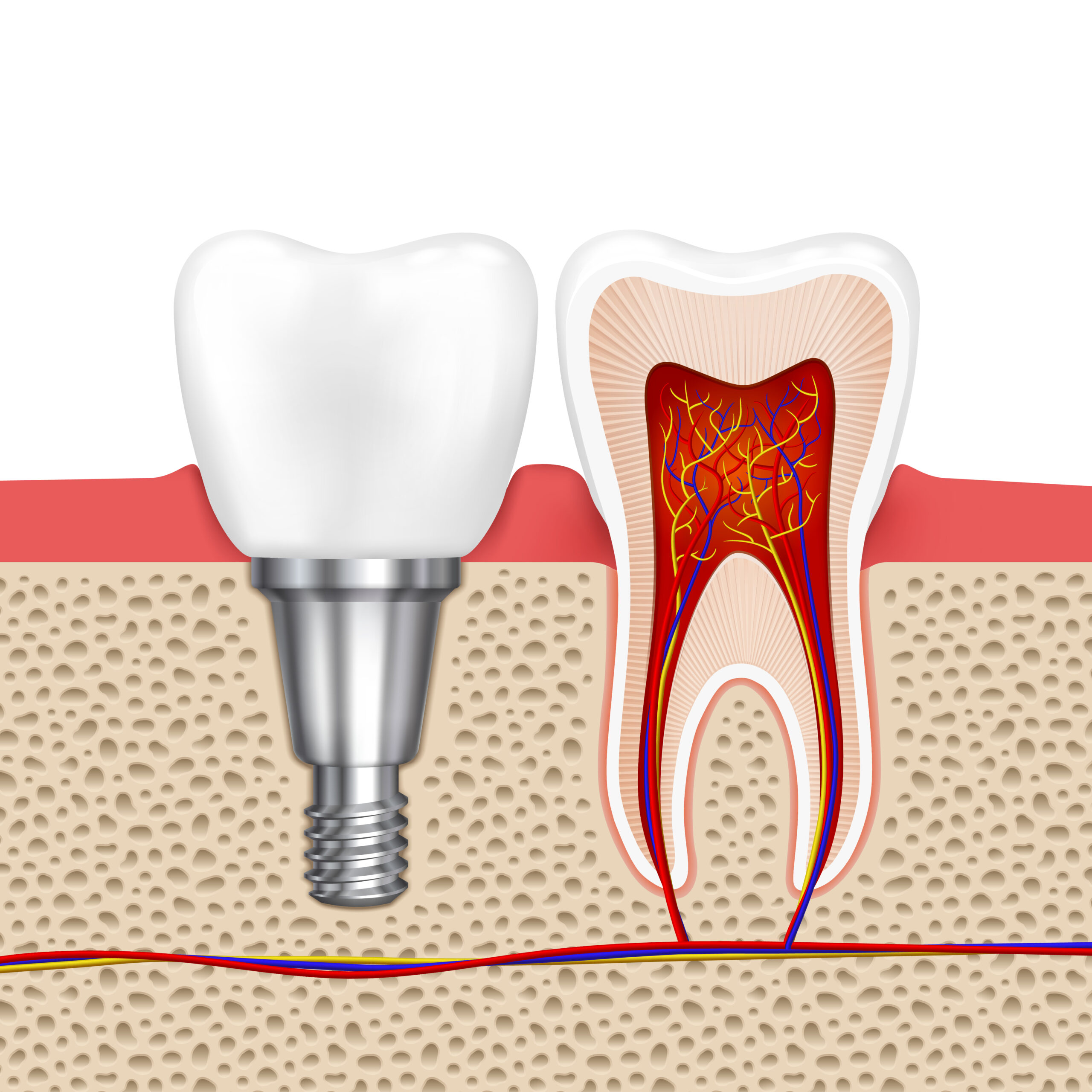 Dental Implants Madurai