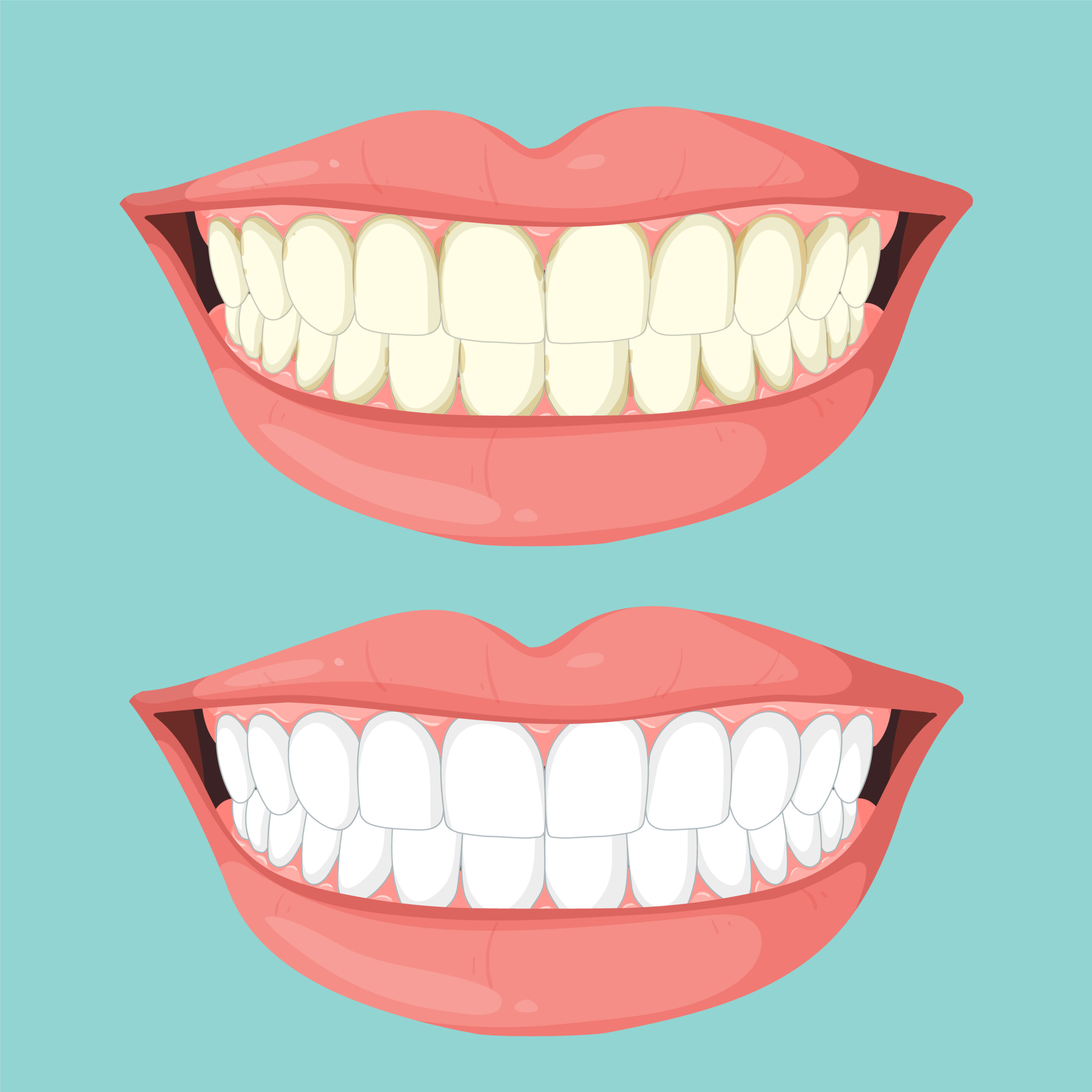 Teeth Whitening Madurai